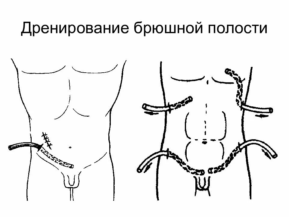 Аппендэктомия дренирование брюшной полости. Дренирование брюшной полости по Генералову. Принципы дренирования брюшной полости при перитоните. Точки дренирования брюшной полости. Абдоминальная операция что это