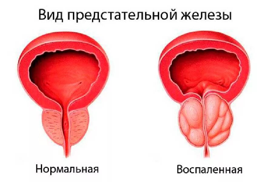 Виды простатита. Предстательная железа вид.