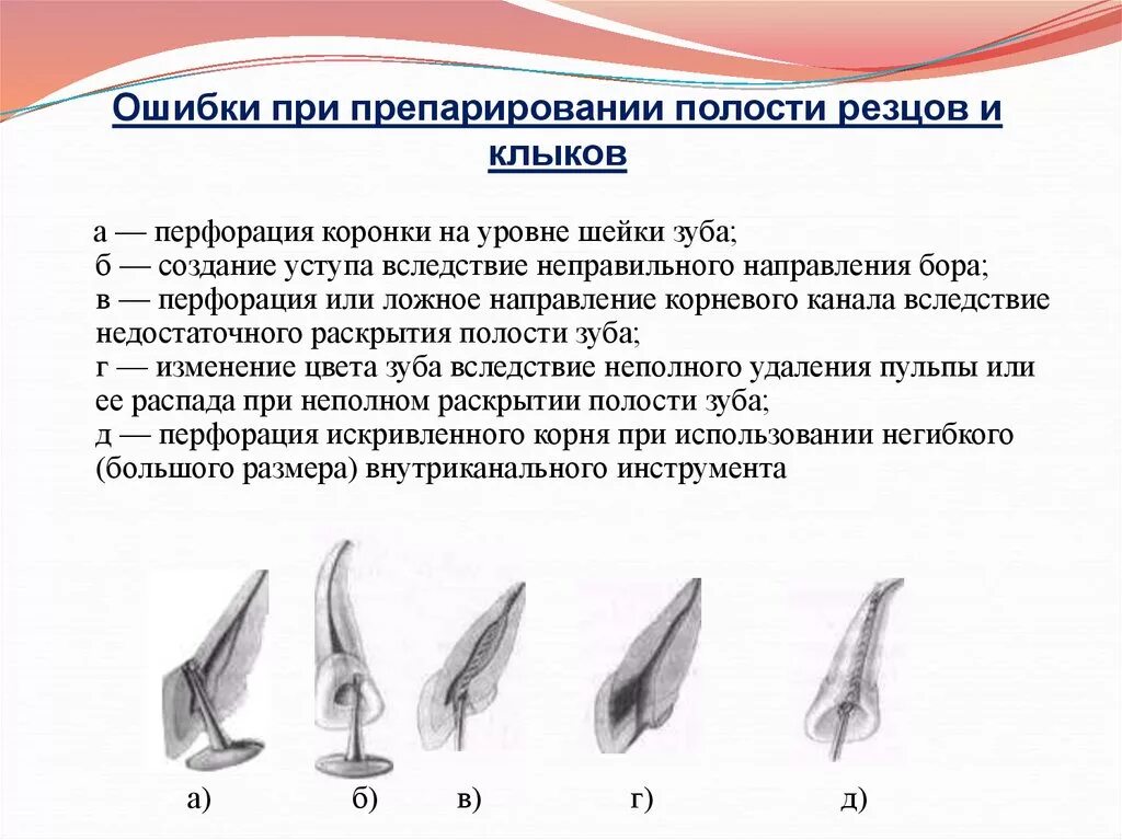 Препарирование корневого канала