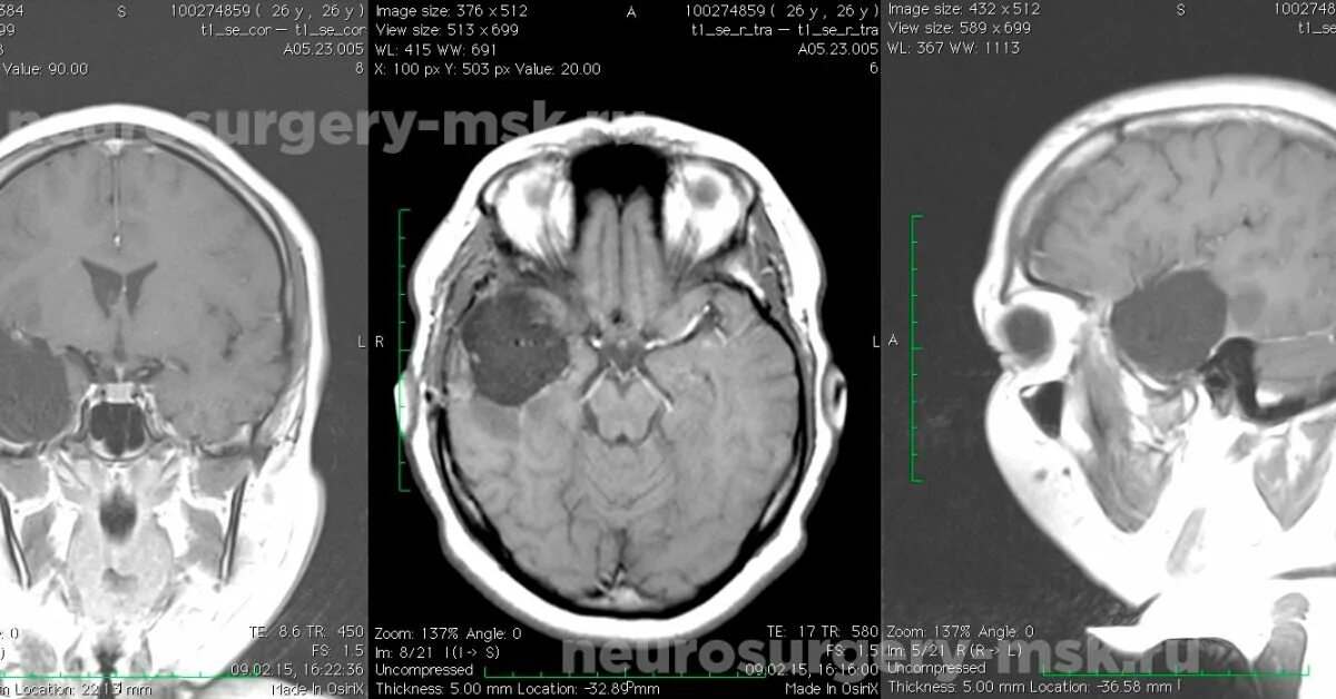 Астроцитома головного мозга прогноз. Менингиома клиновидной кости. Резекция правой височной доли. Астроцитома доброкачественная или злокачественная. Глиальная опухоль височной доли.