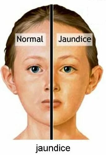 Как выглядит пожелтевшая кожа Alcoholic jaundice Stock Image M190/0123 Science Photo Library