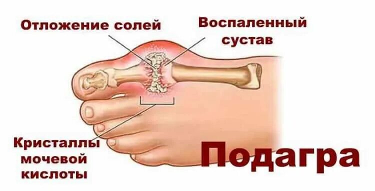 Суставы болят соль