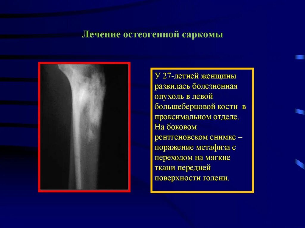 Чем отличается саркома. Остеосаркома кости рентген. Саркомы костей рентген. Симптомы саркомы бедренной кости у детей. Опухоли бедренной кости на рентгенограммах.