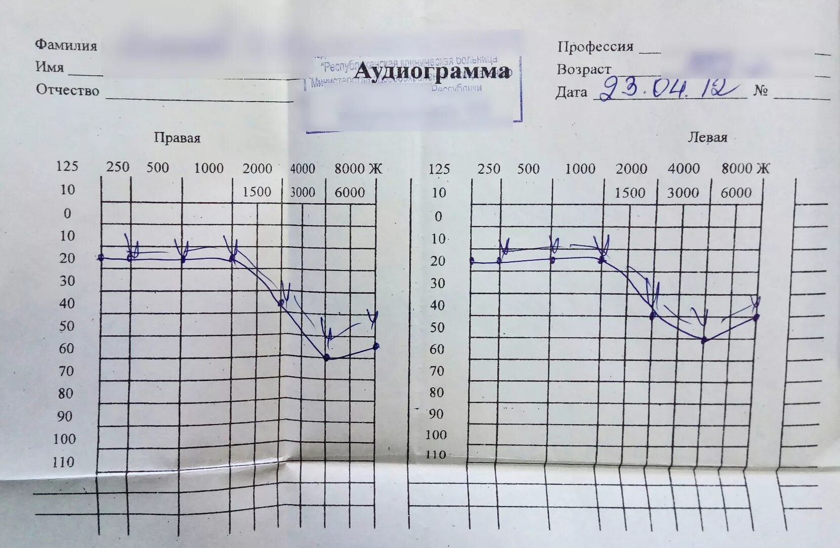 Аудиограмма степени. Аудиометрия тугоухость 1 степени. Падение слуха 1 степени аудиограмма. Аудиограмма слуха норма. Аудиограмма слуха расшифровка.