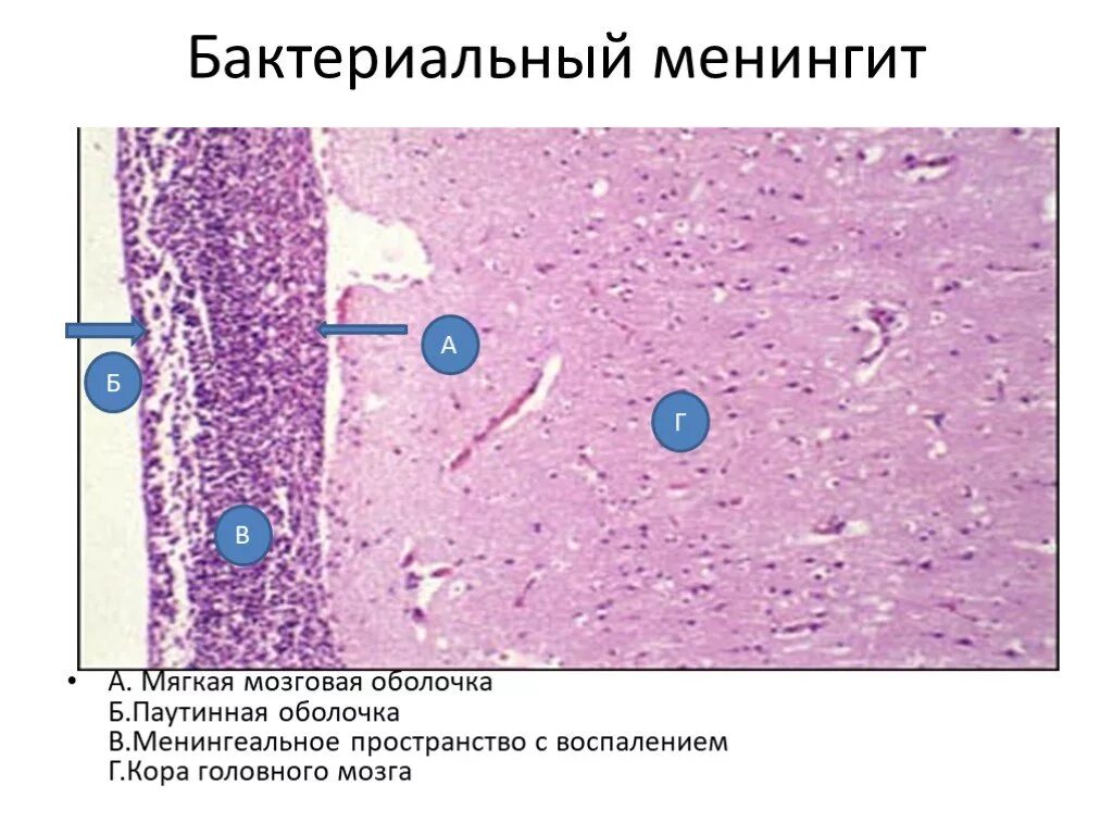 Менингококковый гнойный менингит препарат. Гнойный менингит микропрепарат патанатомия. Менингококковый гнойный менингит препарат. Туберкулезный лептоменингит микропрепарат. Туберкулезный менингит патанатомия.