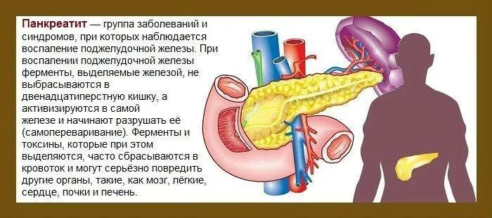 Сильная боль в поджелудочной. Воспалилась поджелудочная железа симптомы. Патология поджелудочной железы симптомы. Панкреатит поджелудочной железы.