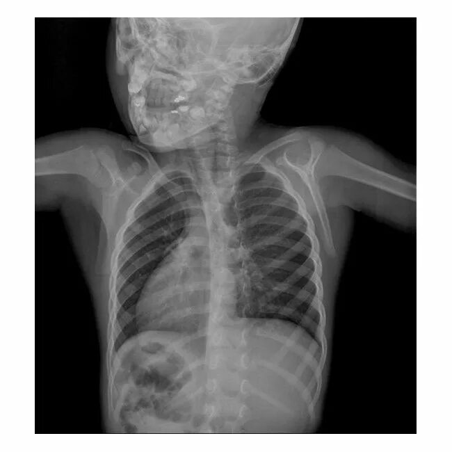 Рентгенограмма детей