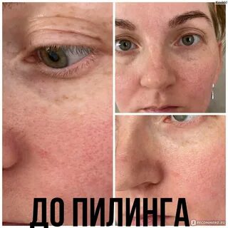 Пилинги от пятен отзывы