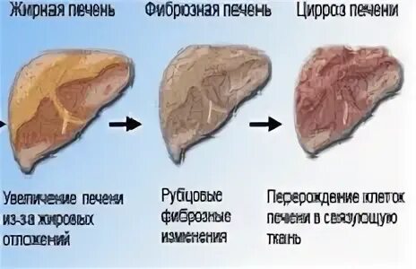 Светлый цвет печени. Диффузные изменения печени. Диффузно измененная печень. Умеренное диффузное изменение печени. Умеренно выраженные диффузные изменения печени.