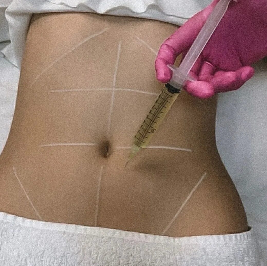 Мультиинжектор линейный на 3 иглы. Мультиинжектор линейный на 5 игл. Мультиинжектор линейный для мезотерапии, на 5 игл. Игла sit для мезотерапии. Мезотерапия тела.