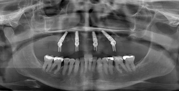 Снимок зубов видное. Имплантация зубов ОПТГ.