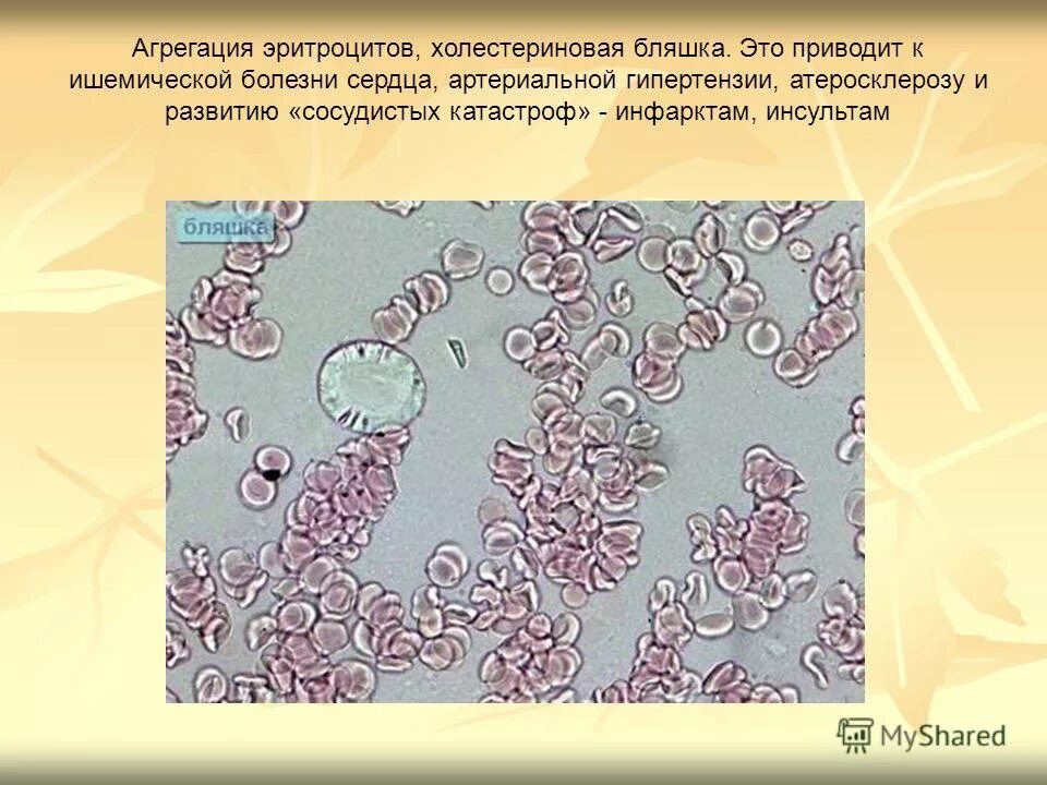 Агрегация форменных элементов крови процесс обратимый. Патогенез основных видов стаза. 6. Механизм развития стаза патофизиология. Феномен внутрисосудистой агрегации форменных элементов.