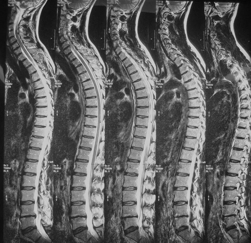 Мрт спинного отдела. Мрт грудного отдела позвоночника сколиоз. Мрт позвоночника снимки.СКИЛОЗ. СКТ позвоночника. Искривление позвоночника на мрт.
