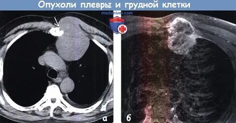 Мягкие ткани грудной клетки