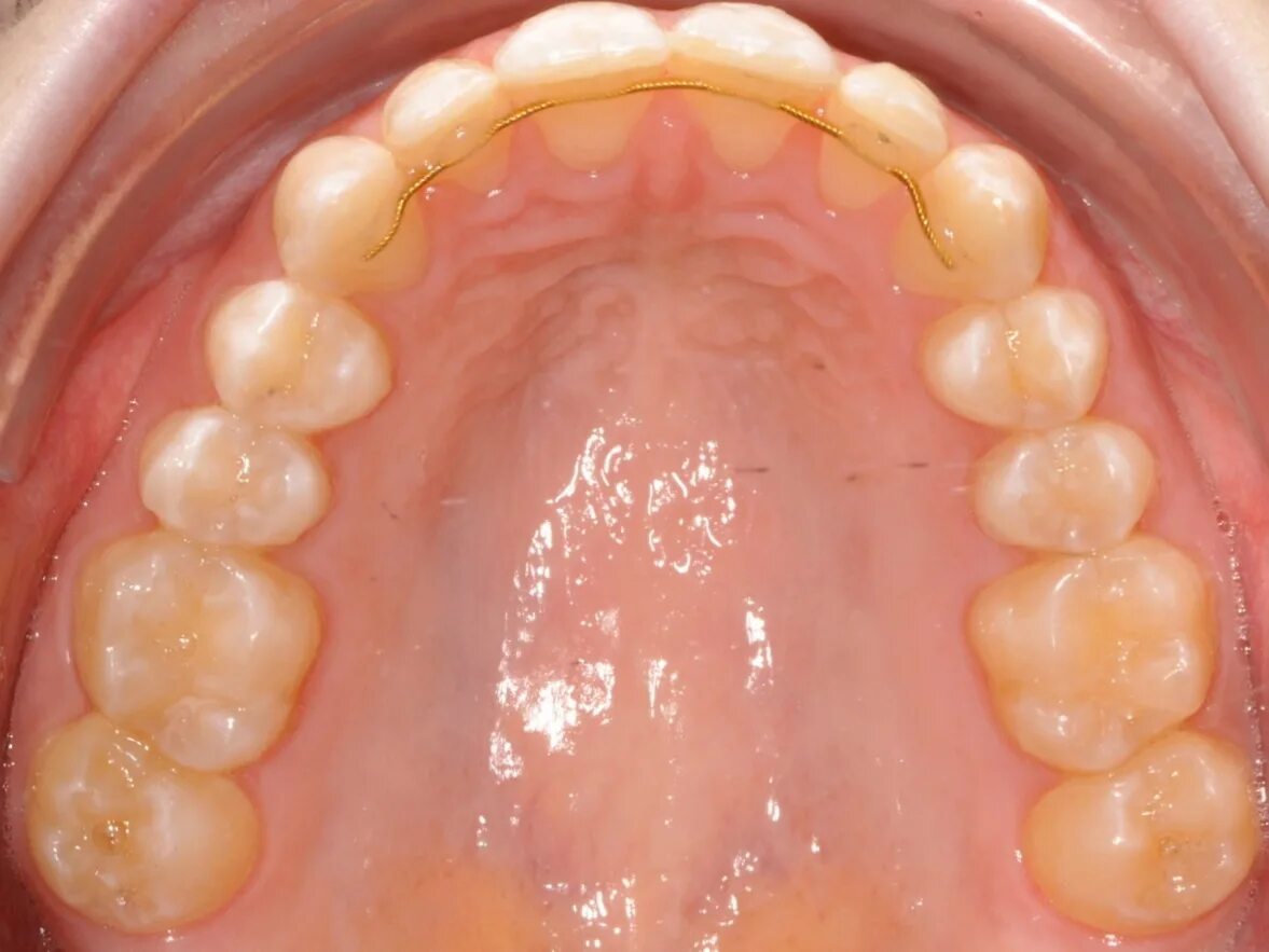 несъемный флекс-ретейнер. шинирование флекс дугой. несъемный флекс-ретейнер. ретейнер ортодонтический. установка ретейнера.