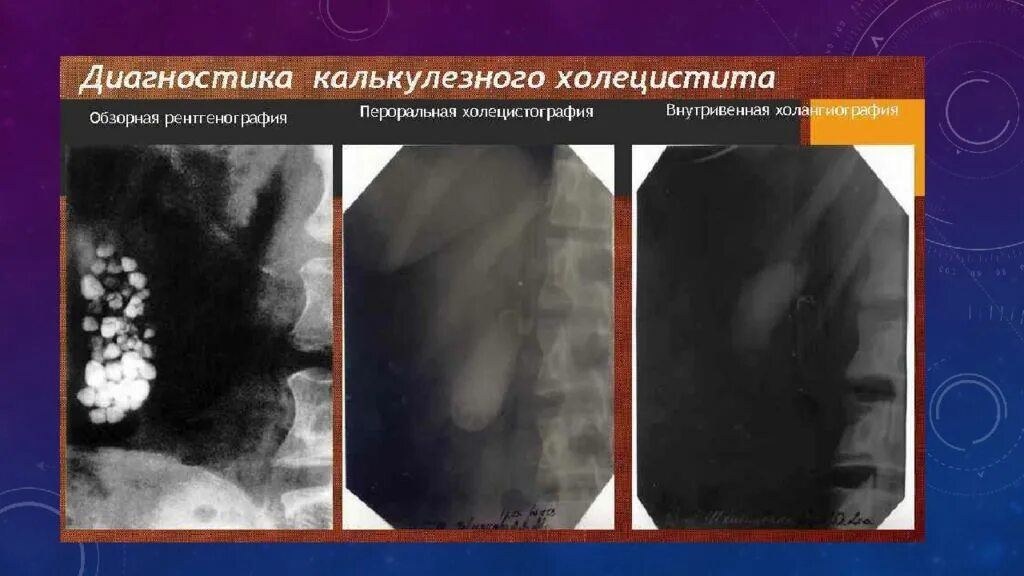 Пероральная холецистография. Холецистография желчнокаменная болезнь. Желчекаменная болезнь рентген. Холецистография и холангиография. Калькулезный холецистит рентгенограмма.