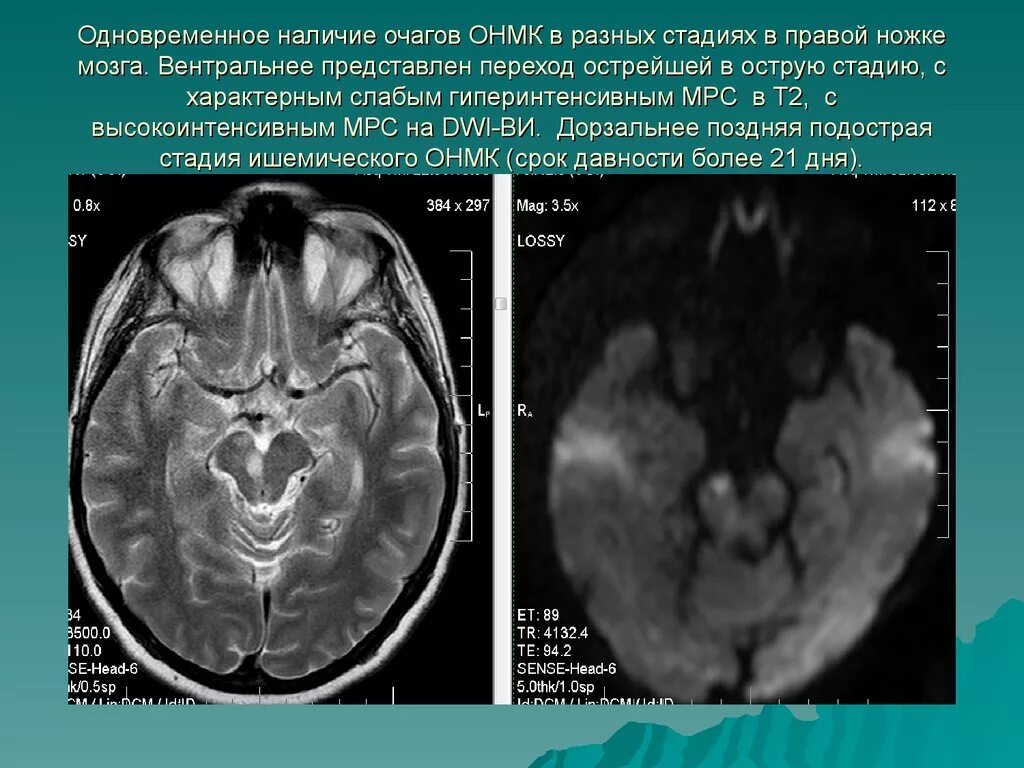 Левая средняя мозговая артерия инсульт. Инсульт ствола мозга мрт. ОНМК подострая стадия. Очаги в стволе мозга на мрт.