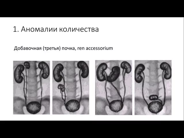 Аномалия развития третья почек удвоение. Аномалии формы мочеточников. Врожденные аномалии развития почек. Аномалии развития почек и верхних мочевых путей.