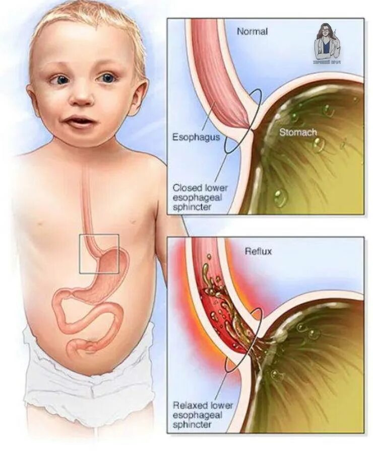 Желудок новорожденного ребенка. Возникновению гастроэзофагеального рефлюкса у детей. Пищеводный рефлюкс у ребенка. Пищевод и желудок у детей.