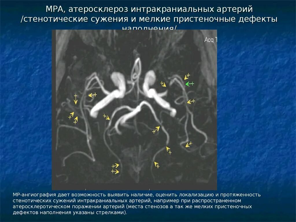 Интракраниальные артерии головного мозга. Мрт ангиография интракраниальных сосудов. Мрт головного мозга и МР-ангиография интракраниальных артерий. Атеросклероз сосудов головного мозга ангиография. Стеноз мозговых артерий мрт.