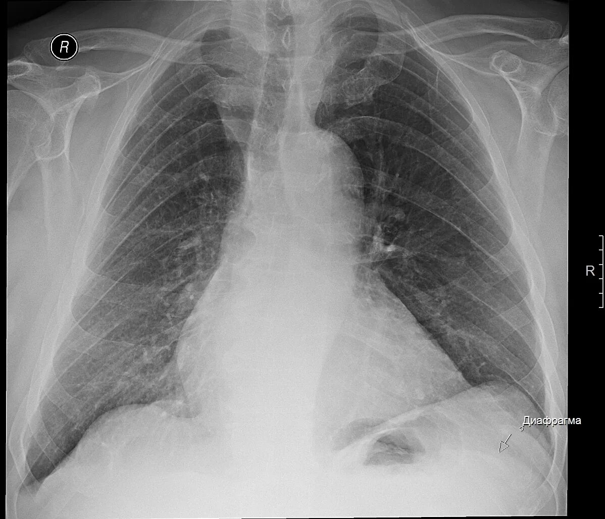 Грыжа купола диафрагмы рентген. Двойной контур диафрагмы на рентгене. Релаксация купола диафрагмы на рентгенограмме. Релаксация диафрагмы на рентгенограмме. Релаксация купола диафрагмы что это такое