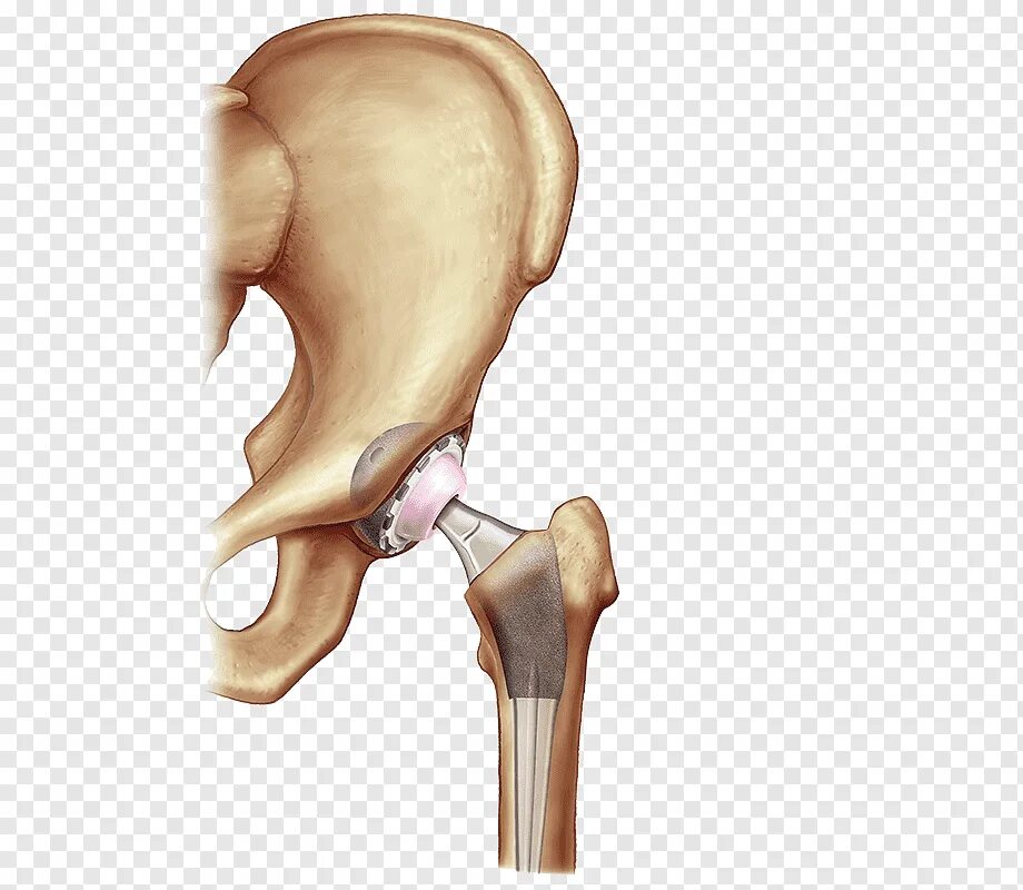 Эндопротез шейки бедра. Артроскопия тазобедренного сустава. Эндопротез коленного сустава Maxx Orthopedics. Эндопротез тазобедренного сустава PNG.