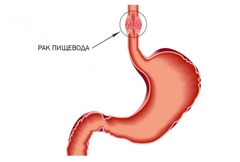 С г пищевода