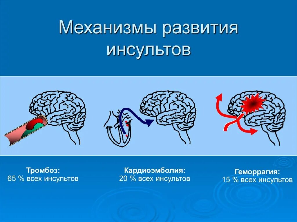 Инсульт развитие речи. Механизм инсульта. Развитие инсульта. Этиология инсульта. Для инсульта развивающегося по механизму.