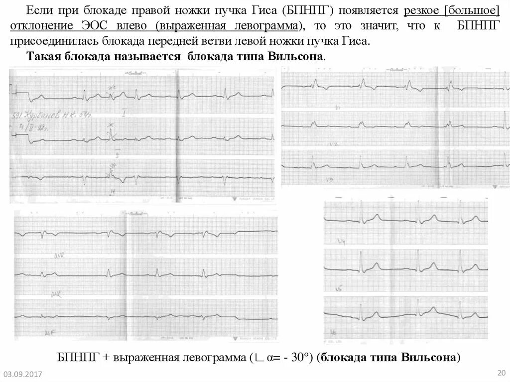 Нарушение блокады гиса. БПНПГ на ЭКГ. Неполная блокада передней ветви ЛНПГ на ЭКГ. Отклонение ЭОС влево, блокада правой ножки пучка Гиса;. Блокада ПНПГ на ЭКГ.