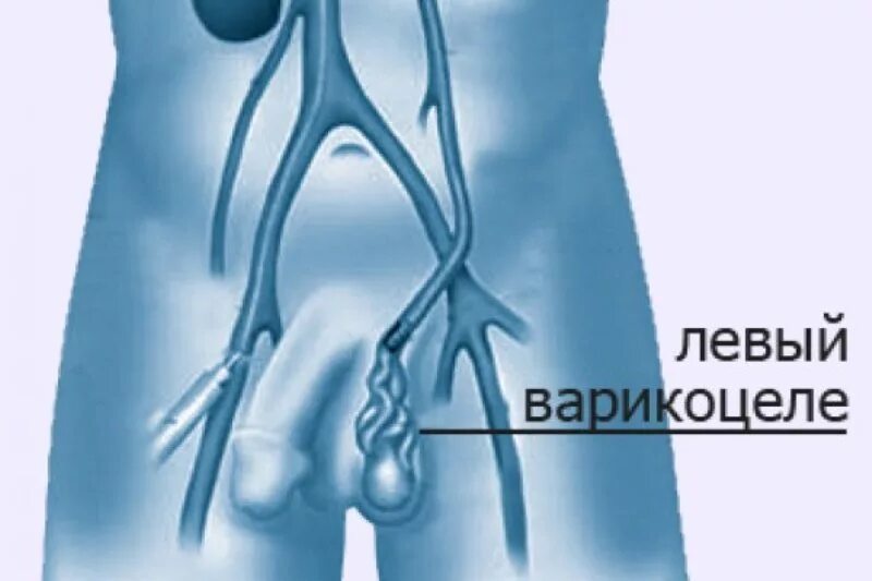 Расширение вен канатика. Варикоцеле-расширение вен семенного канатика яичка. Варикоз вен семенного канатика. Левосторонний варикоз вены семенного канатика.