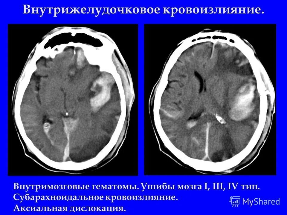 Внутрижелудочковая гематома. Вентрикулярное (желудочковое) кровоизлияние. Внутримозговое кровоизлияние внутрижелудочковое. Внутримозговое кровоизлияние внутрижелудочковое. Внутрижелудочковое кровоизлияние.