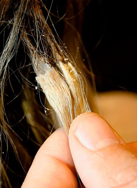 Узелковая трихоклазия. Луковица волоса. Волос с волосяной луковицей. Корень волоса.