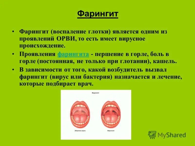 Фарингит Народная медицина