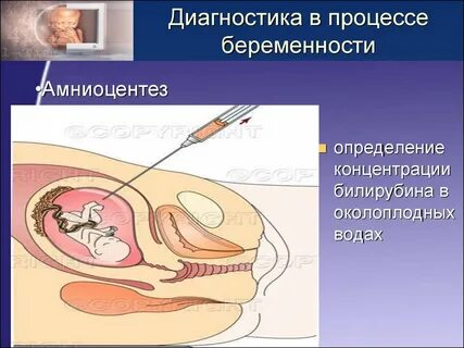 Кто делал амниоцентез форум