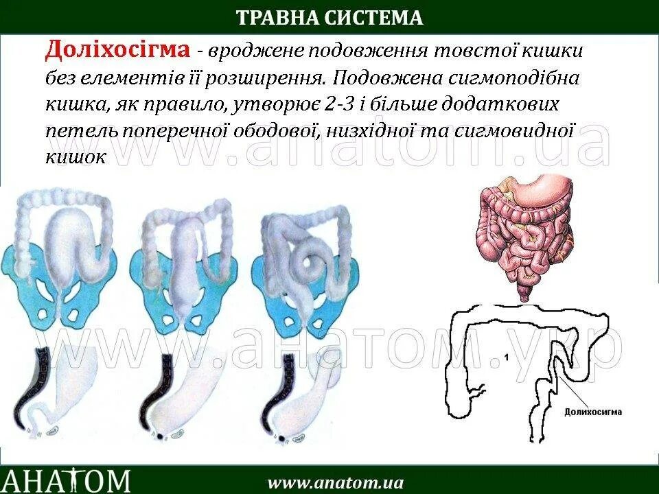 Долихосигма что это такое симптомы. Долихосигма что это такое симптомы