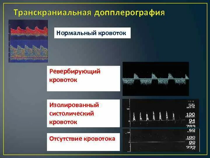 Реверберирующий кровоток при допплерографии. Допплерография кровотока. Транскраниальная допплерография. Транскраниальная допплерография (ТКДГ. Транскраниальных артерий и вен