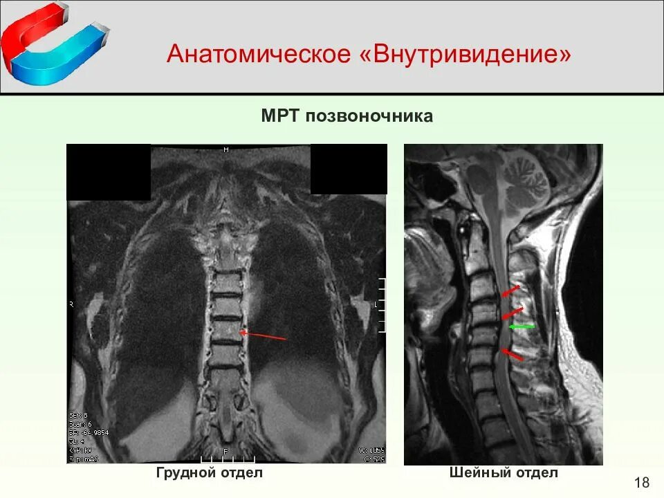 Мрт шейного отдела позвоночника по времени. Мрт шейного отдела позвоночника сколиоз. Мрт шейного отдела позвоночника снимки. Мрт шейно-грудного отдела. Мрт грудного отдела позвоночника сколиоз.