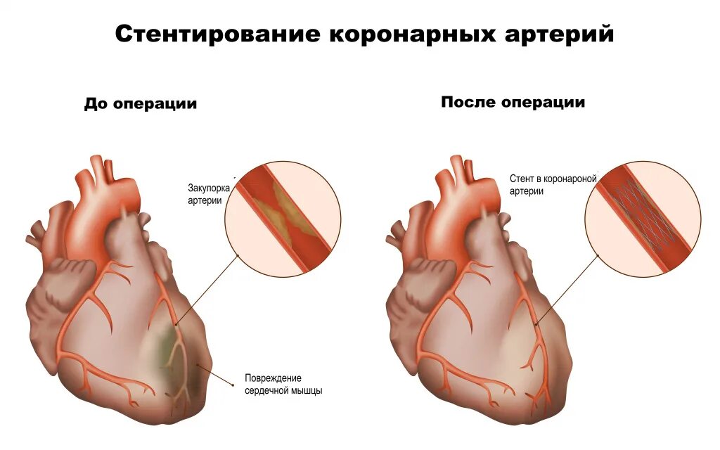 Коронарная ишемия. Коронарная болезнь сердца. Ишемическая кардиопатия.