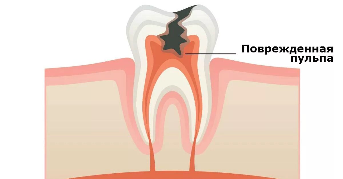 Воспаление канала зуба