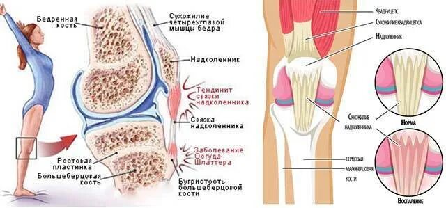 Воспаление коленных связок лечение. Тендинопатия сухожилия коленного сустава. Тендинопатия сухожилия подколенной мышцы. Тендинит четырехглавой мышцы коленного сустава. Связки и сухожилия надколенника.