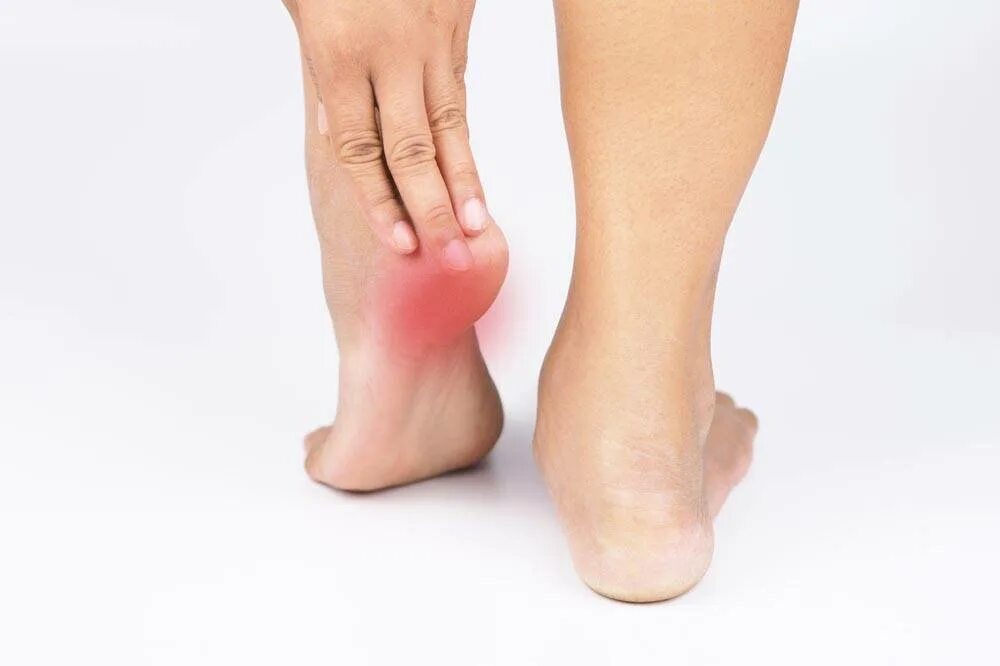 Шпора на ноге симптомы