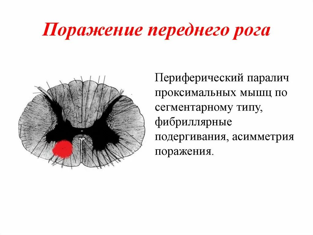 Поражение передних рогов. Синдром поражения переднего рога спинного мозга. Поражение передних Рогов спинного мозга. Симптомы поражения передних Рогов спинного мозга. Поражение мотонейронов передних Рогов спинного мозга.