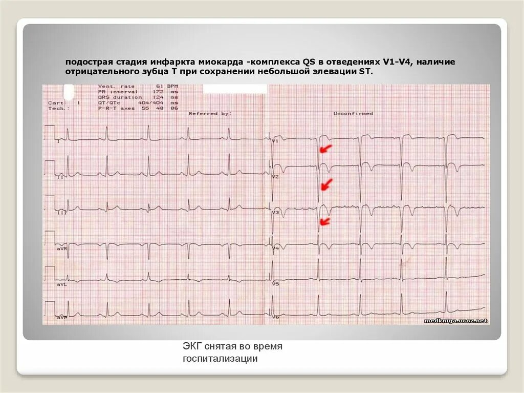Подострая стадия инфаркта на ЭКГ. Подострая стадия инфаркта миокарда на ЭКГ. Подострый период инфаркта миокарда на ЭКГ. Подострый инфаркт ЭКГ. Отведение v1 на экг