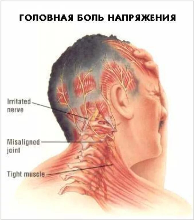 Ощущения в голове что шевелится. Болит голова. Головная боль напряжения. Головная юоль напряжения. Боль в затылке.