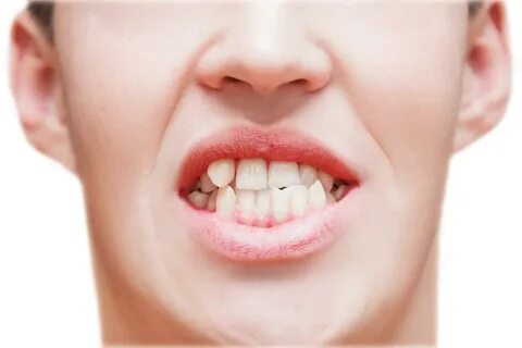 Bare teeth