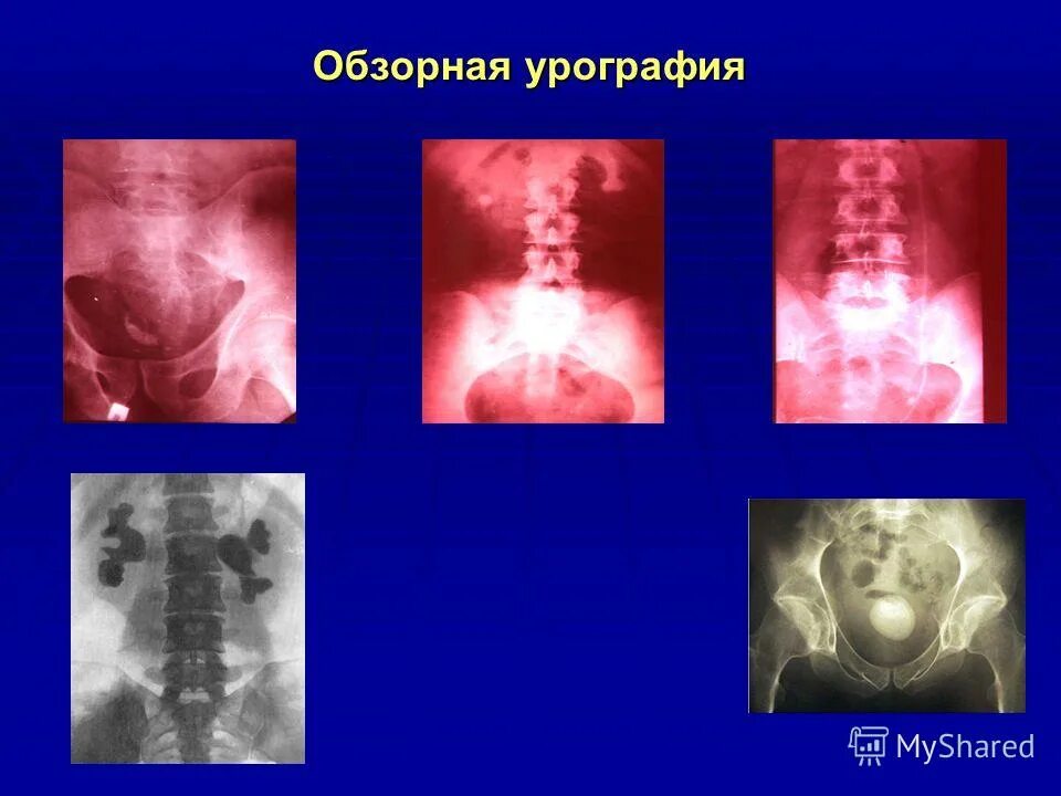 После урографии