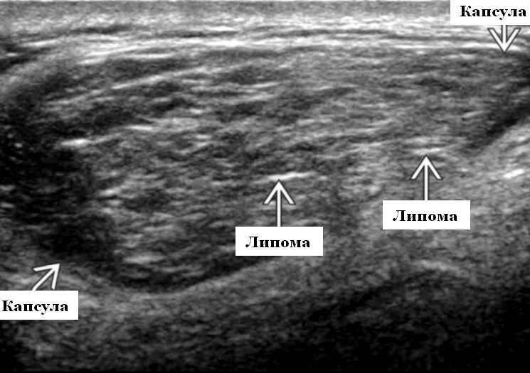 Как отличить на узи. Липома мягких тканей на УЗИ. Предбрюшинная липома УЗИ. Фибролипома УЗИ картина. Липома на УЗИ мягких тканей шеи.