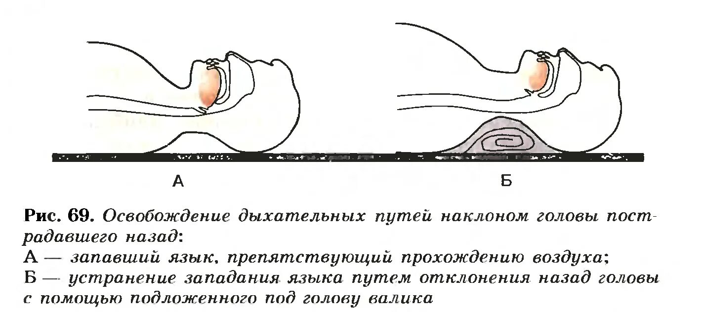 Первая помощь при заваливании. Оказание первой помощи при удушье алгоритм. Первая помощь при удушении и заваливании. Первая помощь при удушении и заваливании землей. Первая помощь при удушении и заваливании землей.