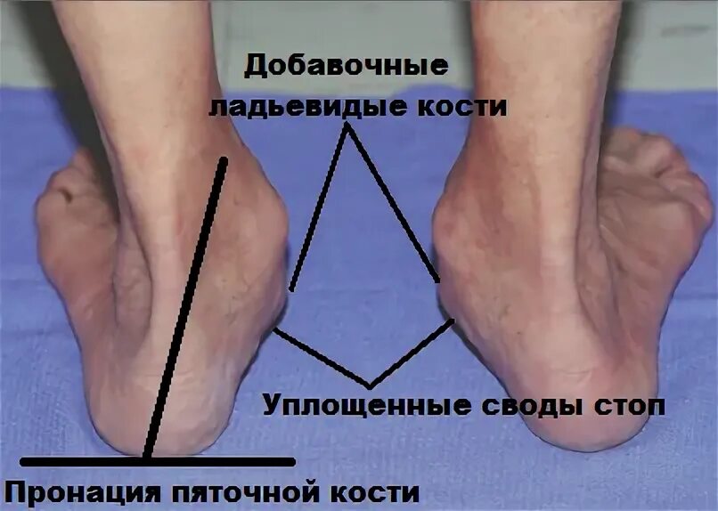 Изменения стопы. Ладьевидная кость плоскостопие. плоскостопие таранная кость. вальгусное плоскостопие косточками. добавочная ладьевидная кость стопы.