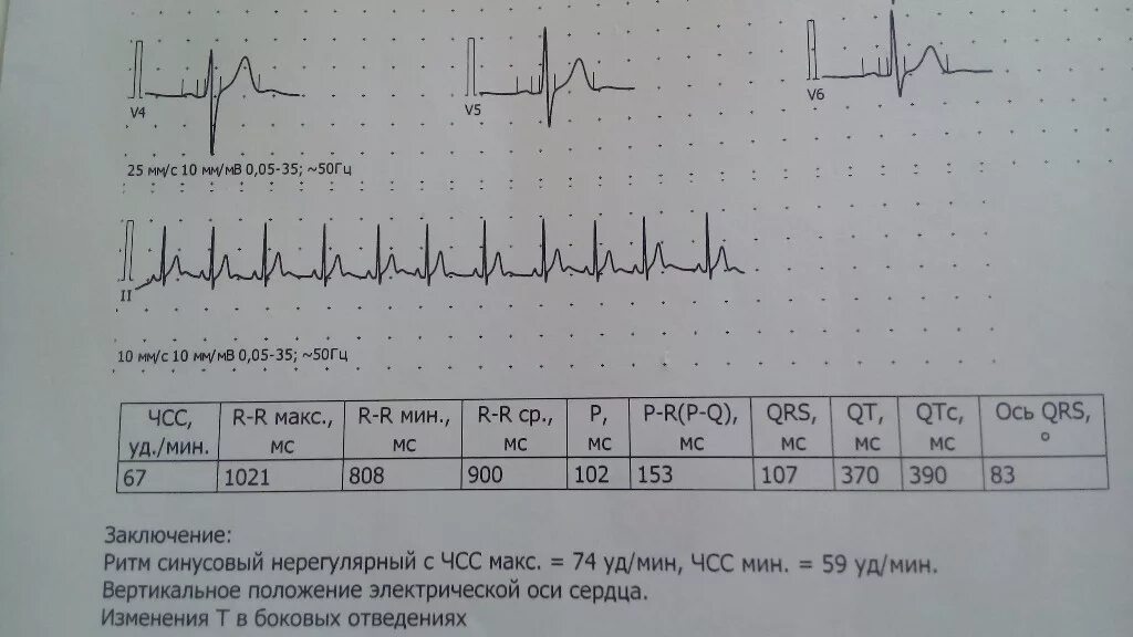 Кардиограмма сердца расшифровка норма у взрослых. Экг чсс норма у взрослых женщин. нормы экг у взрослых таблица. норма чсс на экг у женщин. электрокардиография норма у женщин.